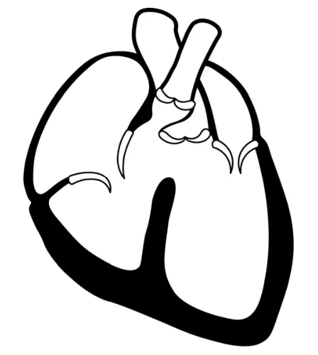 Tekening van een hart met een wijde aorta, een nauwe longslagader en een opening tussen de linker- en de rechterkamer.