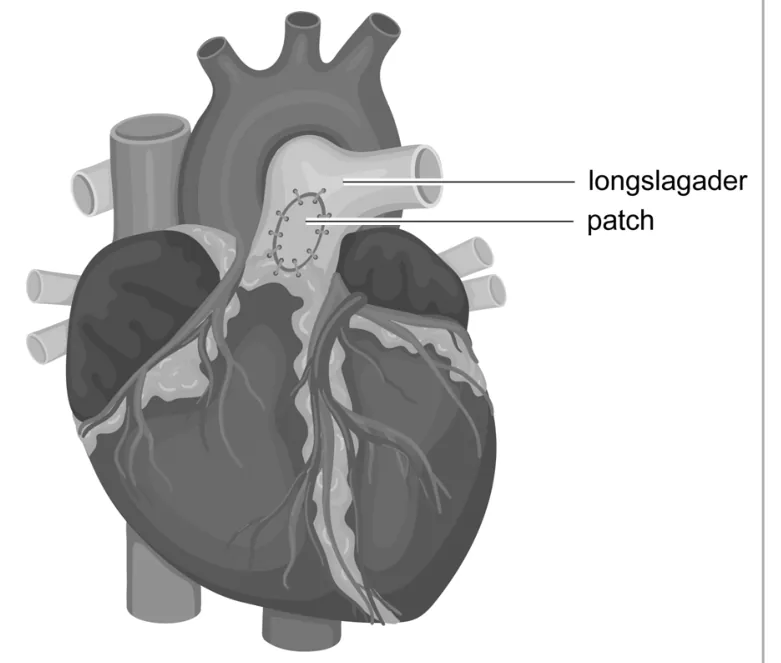 Hart van voren met de longslagader en de patch die in de wand van de longslagader is aangebracht.