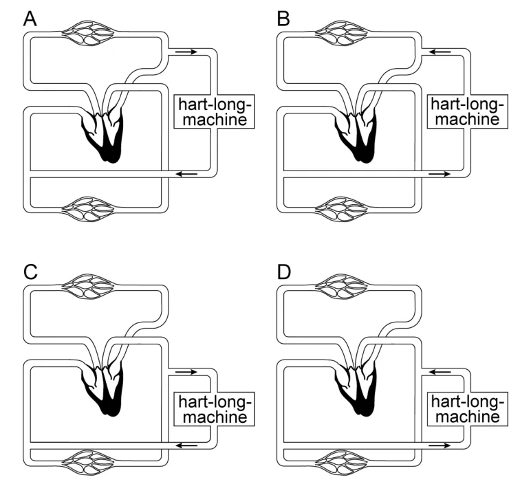 Vier schema's, A tot en met D, van de bloedsomloop met een hart-longmachine. Pijlen geven de stroomrichting van het bloed aan.